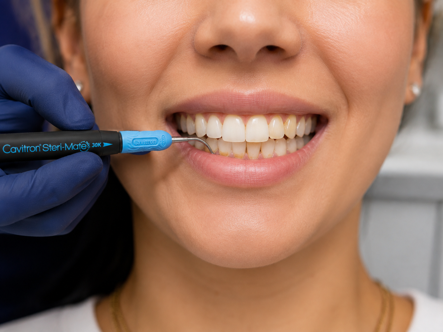 Ultrasonic scaling during a dental hygiene appointment